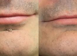 ODALIT® 2-in-1 Microneedle & Hydrocolloid Patch🍀| Removes Raised Moles, Acne, Flat Warts & Skin Tags | Helps Improve Wrinkles, Scars & Blemishes | Invisible Patches for Face & Body
