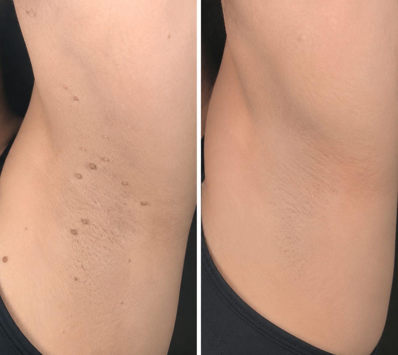 ODALIT® 2-in-1 Microneedle & Hydrocolloid Patch🍀| Removes Raised Moles, Acne, Flat Warts & Skin Tags | Helps Improve Wrinkles, Scars & Blemishes | Invisible Patches for Face & Body