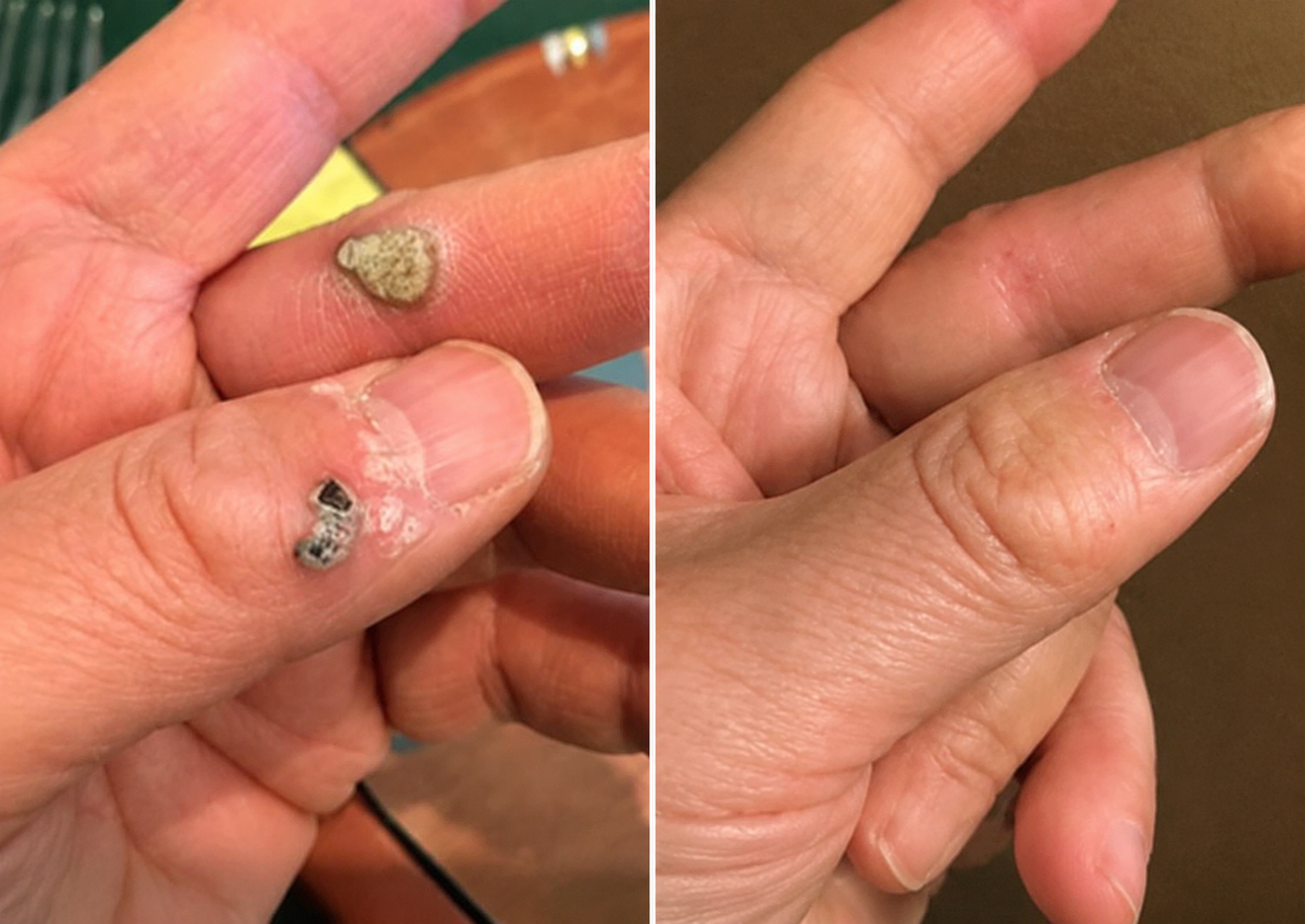 ODALIT® 2-in-1 Microneedle & Hydrocolloid Patch🍀| Removes Raised Moles, Acne, Flat Warts & Skin Tags | Helps Improve Wrinkles, Scars & Blemishes | Invisible Patches for Face & Body